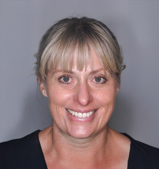 Invisalign and Ceramic Restoration