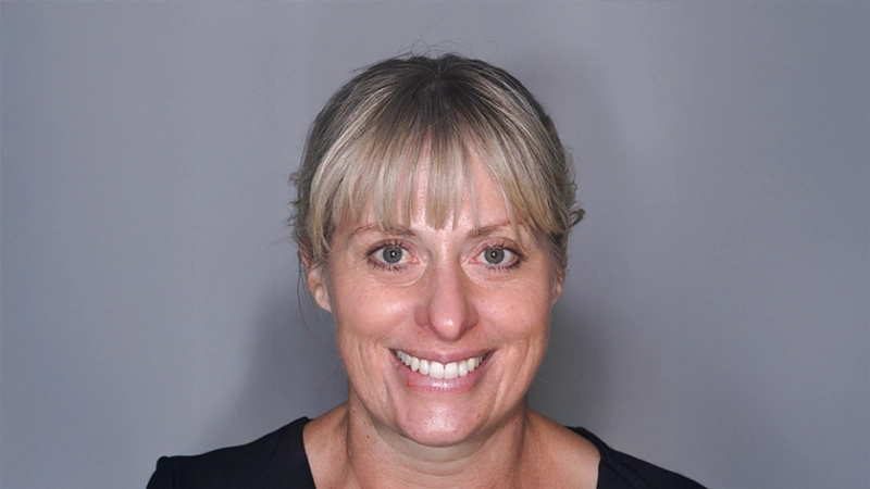 Minimally Invasive, Maximally Effective Smile Transformation