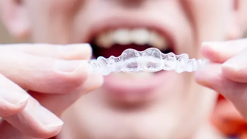 Invisalign for Rotated Lateral Incisors