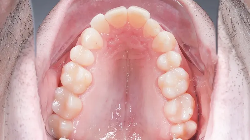 Composite Resin Restorations