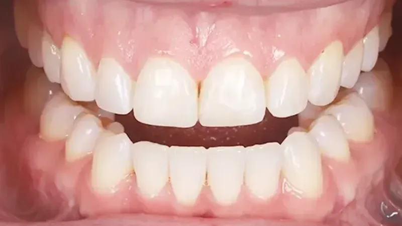Direct composite restorations