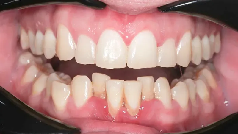 Gum Disease Treatment