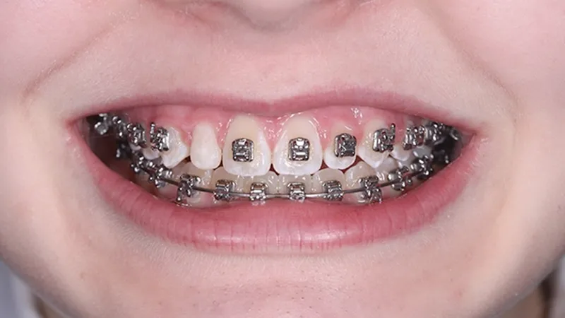 Conservative Resin Veneer