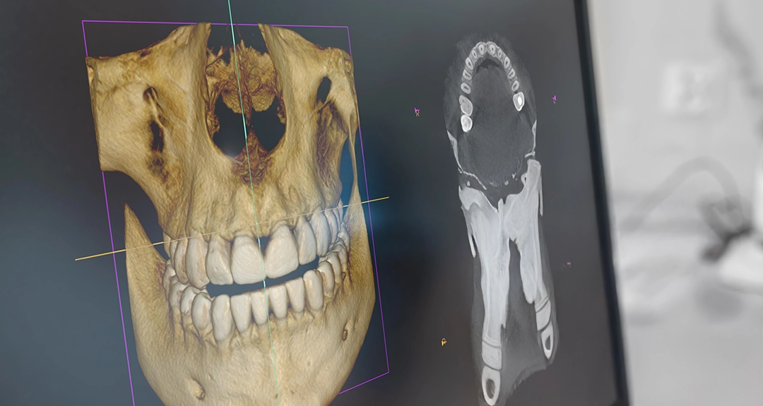 Stop cavities from sneaking under your dental crown