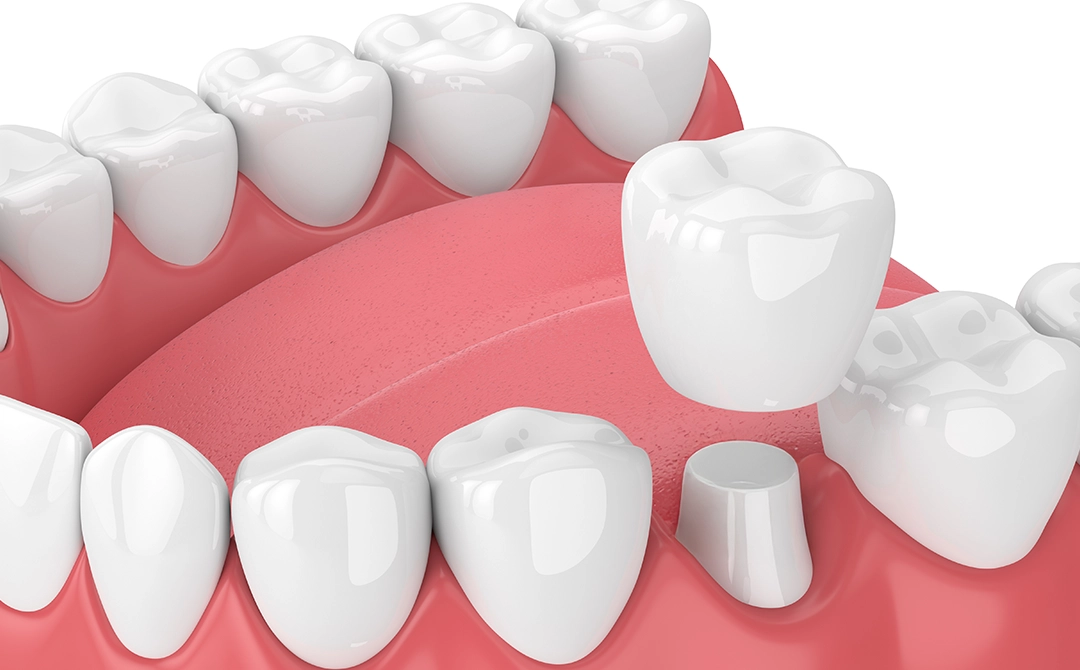 Stop cavities from sneaking under your dental crown