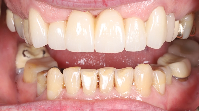 A Functional, Aesthetic Smile at 75