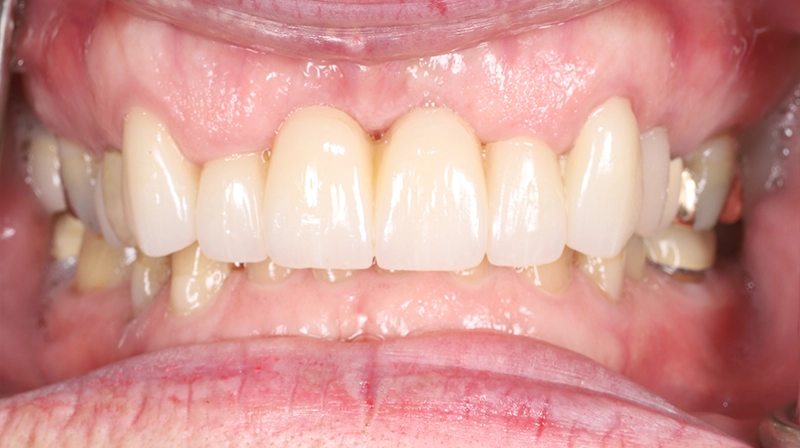 A Functional, Aesthetic Smile at 75