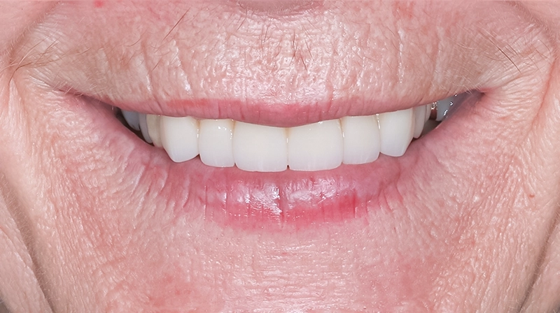 A Functional, Aesthetic Smile at 75