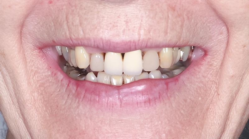 A Functional, Aesthetic Smile at 75