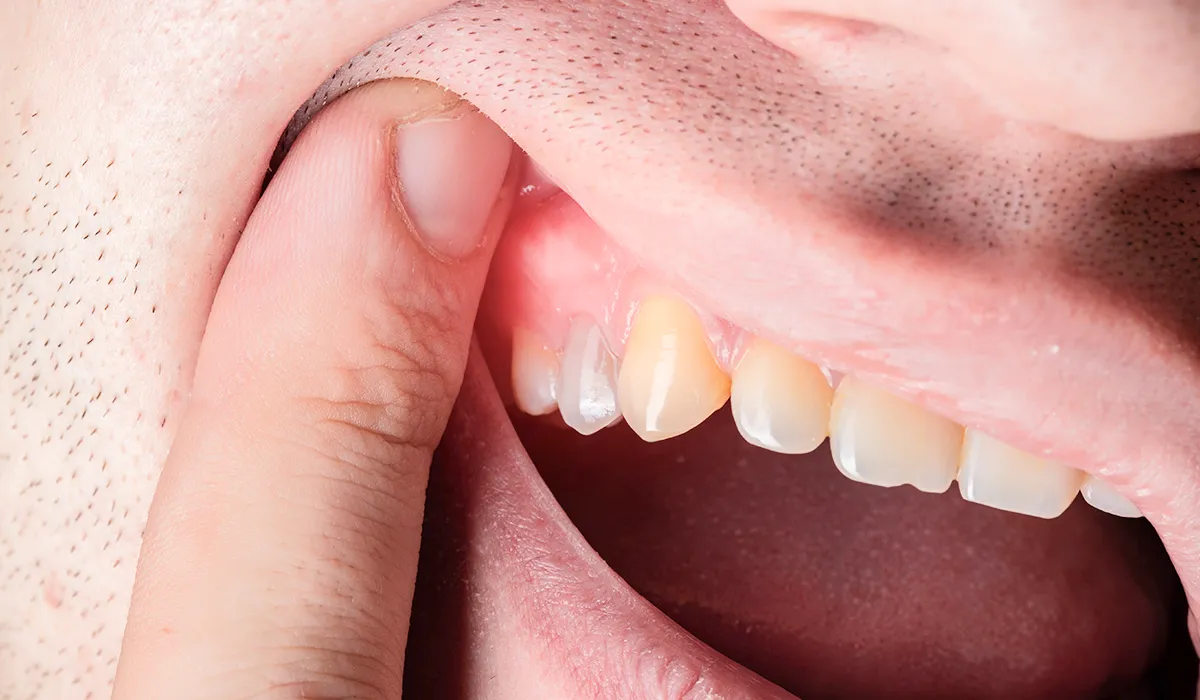 pulp necrosis pulp necrosis