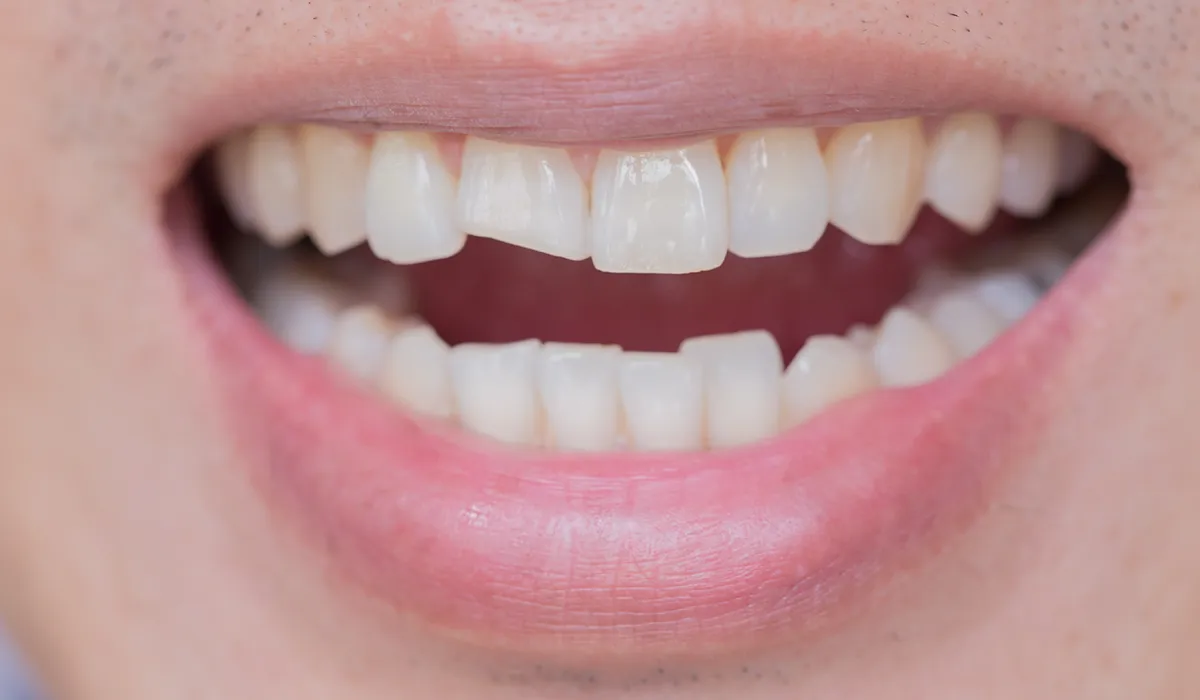 dental trauma dental trauma