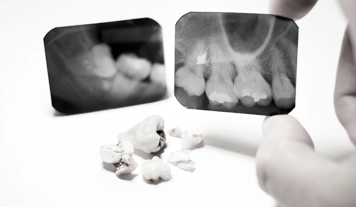 dental trauma dental trauma