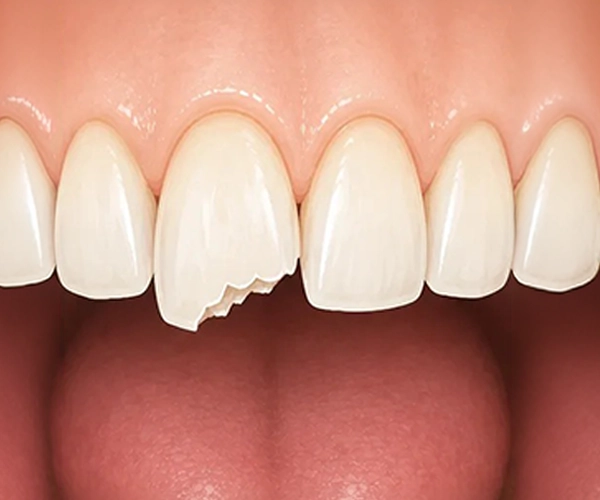 Simply Teeth - Chipped Chipped or fractured teeth