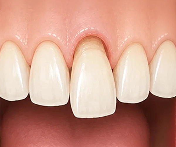Simply Teeth - Dislodged Dislodged or loosened teeth