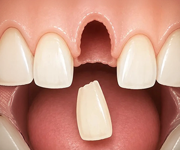 Simply Teeth - Knocked Out Tooth Knocked-out tooth (avulsion)