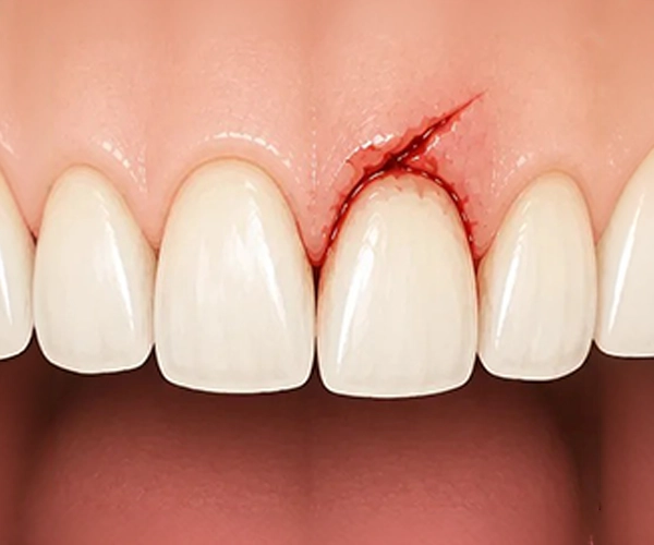 Simply Teeth - Soft Tissue Injuries Soft tissue injuries