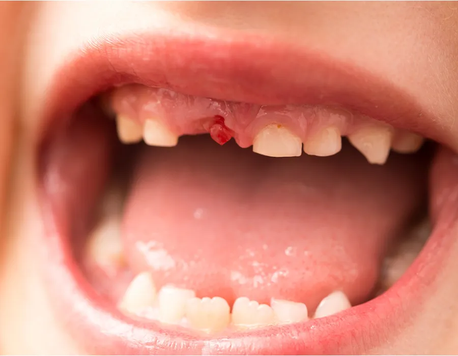 Dental Trauma Dental Trauma